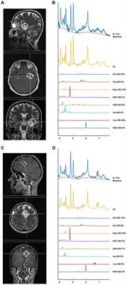Magnetic resonance spectroscopic correlates of progression free and overall survival in “glioblastoma, IDH-wildtype, WHO grade-4”